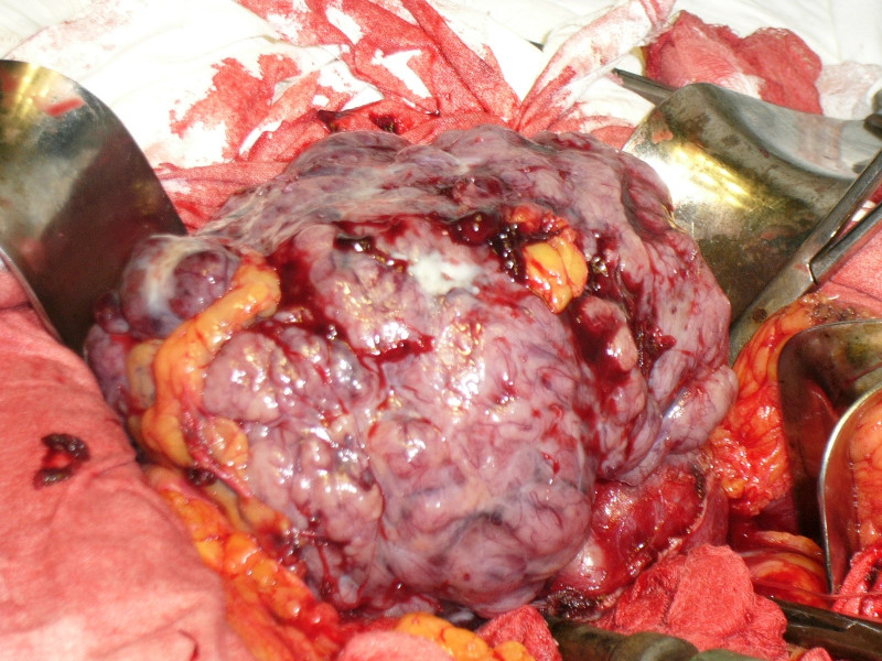 Вид лейомиомы желудка со стороны операционного поля